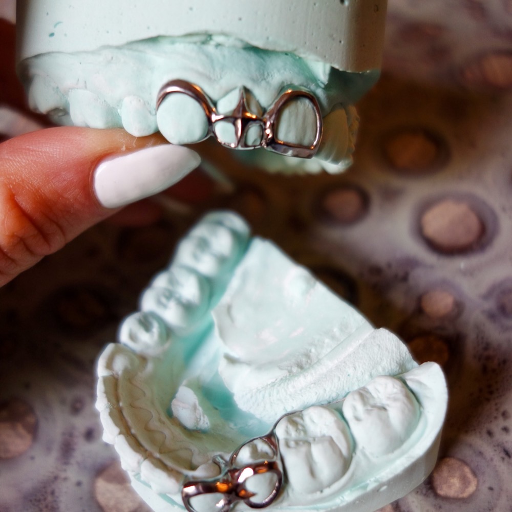 Grillz auf Modell — individuelles Zahnschmuck-Design