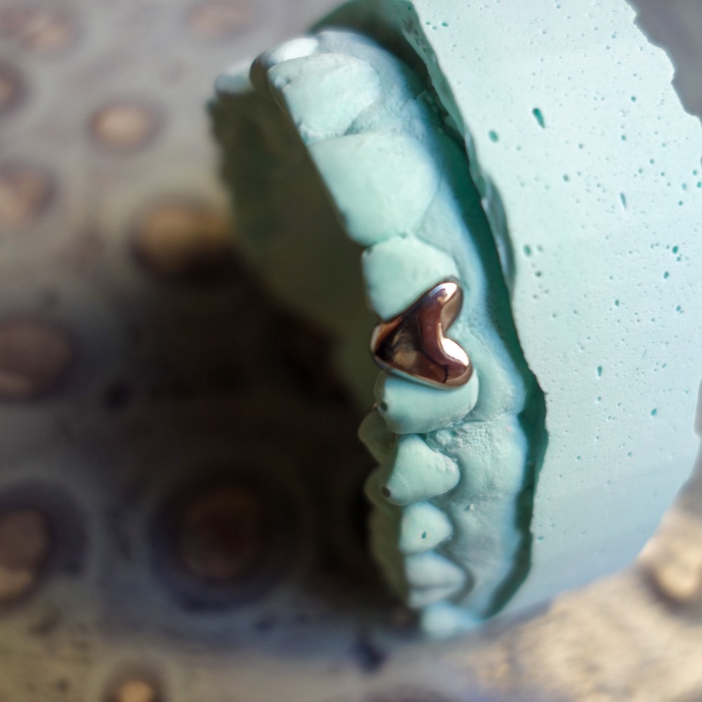 Custom Dental Grillz — Seitenansicht auf Modell