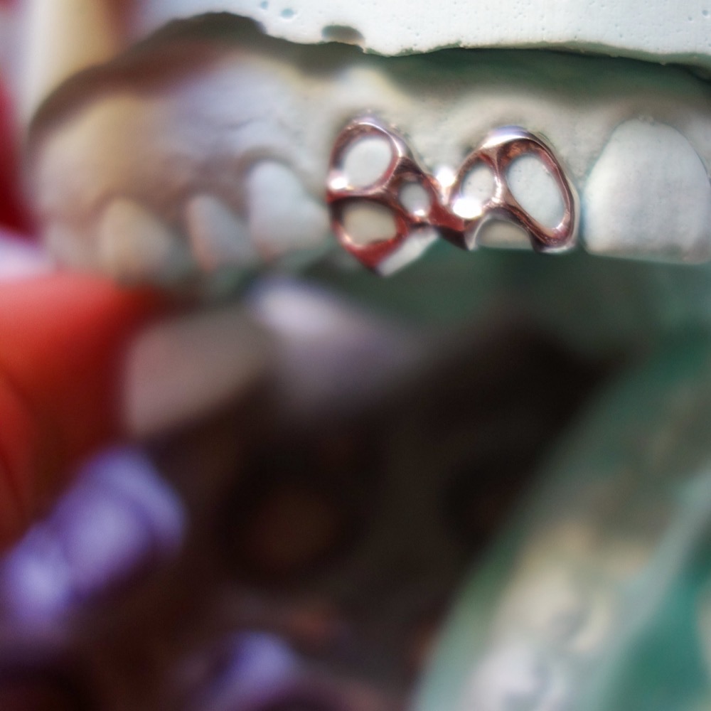 Zahnschmuck Detail — SLM-gefertigte Oberfläche