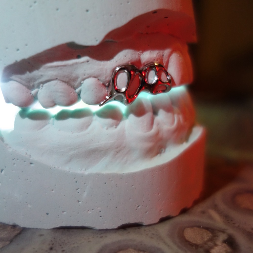 Custom Grillz Gesamtansicht — Dental Jewelry Berlin
